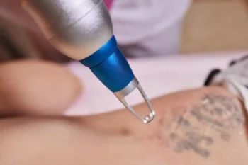 Eliminación de tatuajes